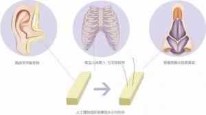 北京米杨丽格整形医院科普：隆鼻材料该怎么选