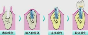 青岛做种植牙贵不贵，【青岛优诺博士口腔】价钱怎么样